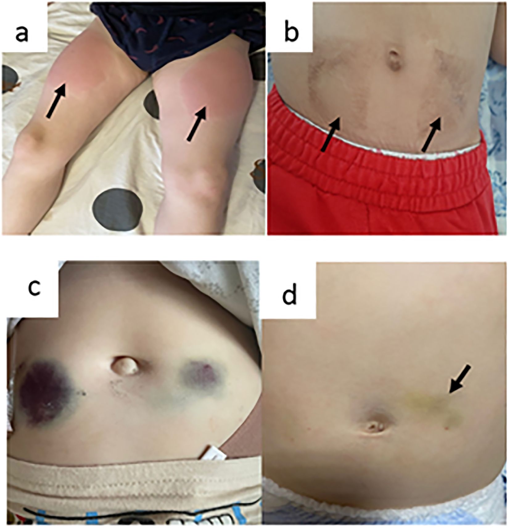 Four images labeled a to d show skin abnormalities. Image a shows redness on the upper legs with arrows pointing to the affected areas. Image b shows darkening around the waistline with arrows highlighting the discoloration. Image c displays significant bruising on the abdomen. Image d has a small yellowish bruise near the navel, marked by an arrow.
