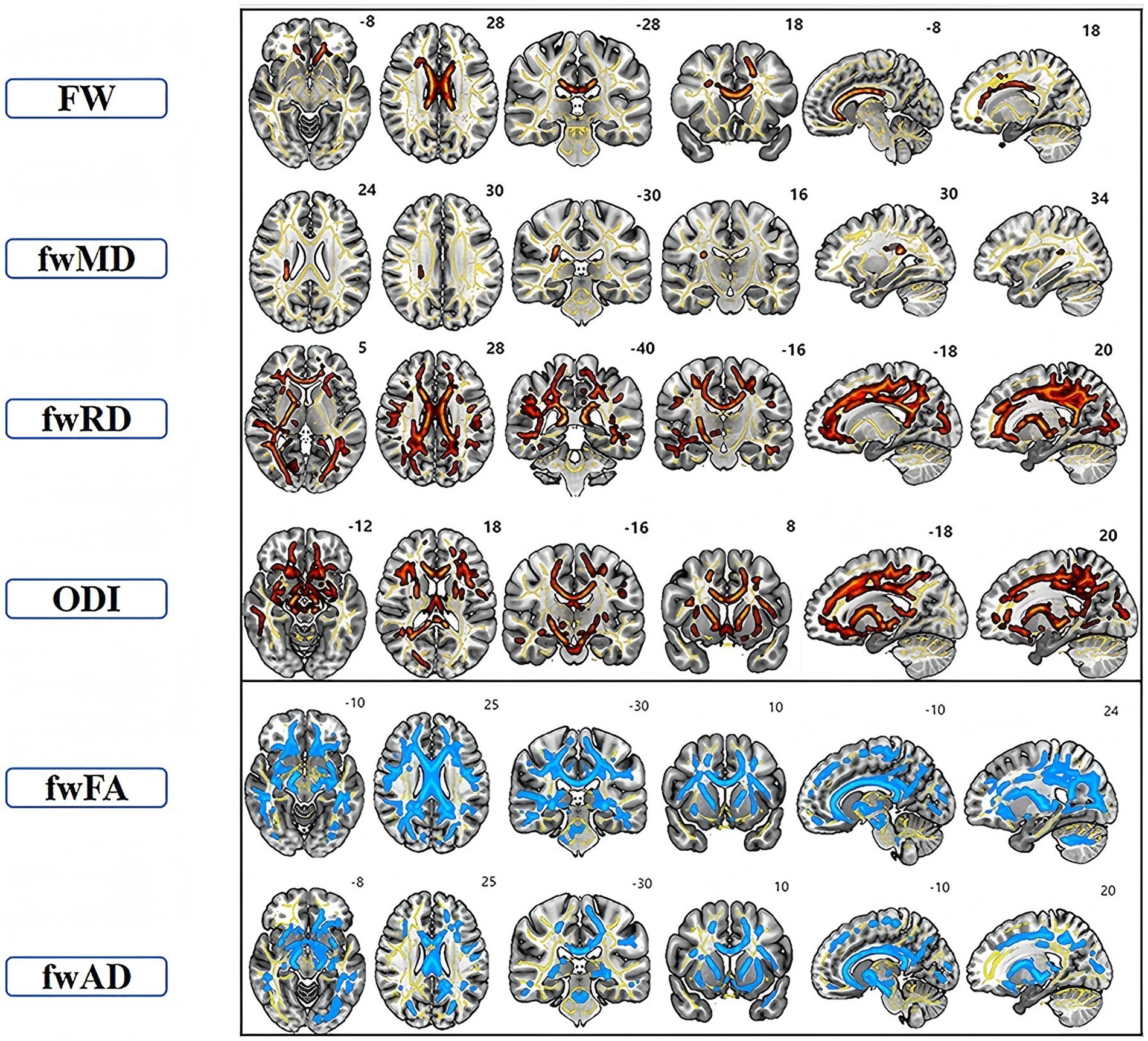 Brain scan images show different diffusion MRI metrics, including FW, fwMD, fwRD, ODI, fwFA, and fwAD. Each row highlights various regions with color-coded areas in red or blue, representing specific analysis results across multiple brain cross-sections.