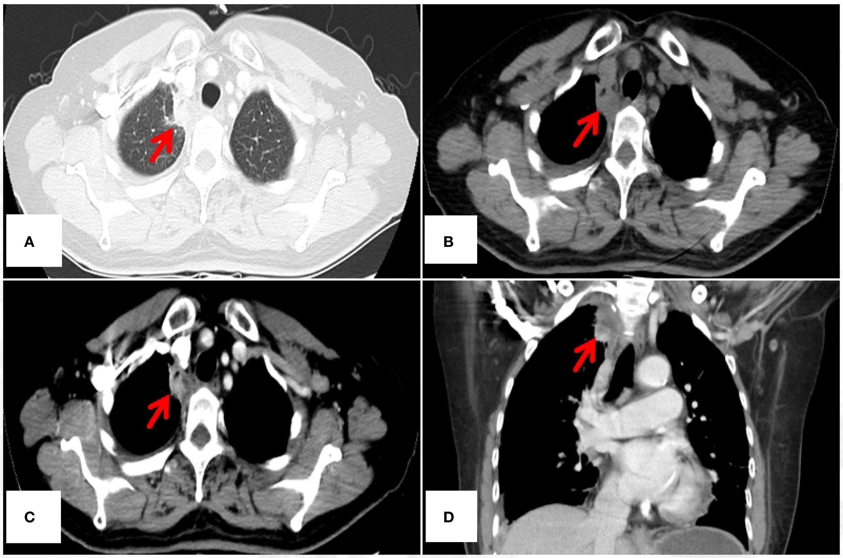 CT scans show four different cross-sectional views of the chest area. Each image has a red arrow pointing to a specific area of interest. Image A displays the axial lung window, highlighting a region in the left lung. Image B shows the axial mediastinal window, focusing on the area near the mediastinum. Image C presents another axial view emphasizing a similar region. Image D offers a sagittal view, with the arrow pointing to a structure in the mediastinum, possibly the esophagus.