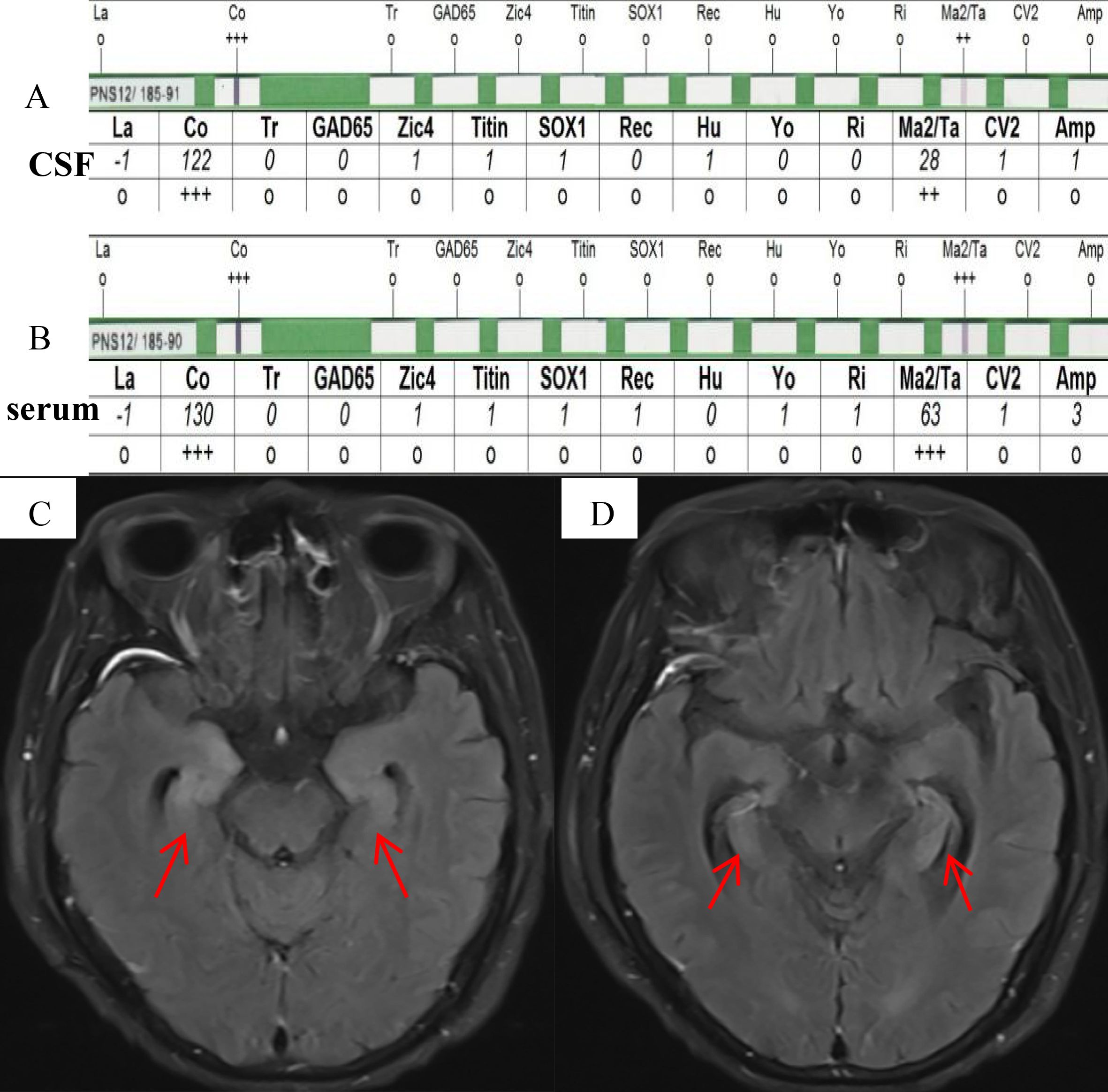 Two images with accompanying data charts are displayed. The upper section shows two charts labeled A (CSF) and B (serum) detailing antibody test results across various parameters, indicated by numbers and symbols. Below are two MRI scans labeled C and D, showing cross-sectional brain images with red arrows pointing to highlighted areas of interest in both images. The images suggest a focus on neurological assessment or diagnosis.