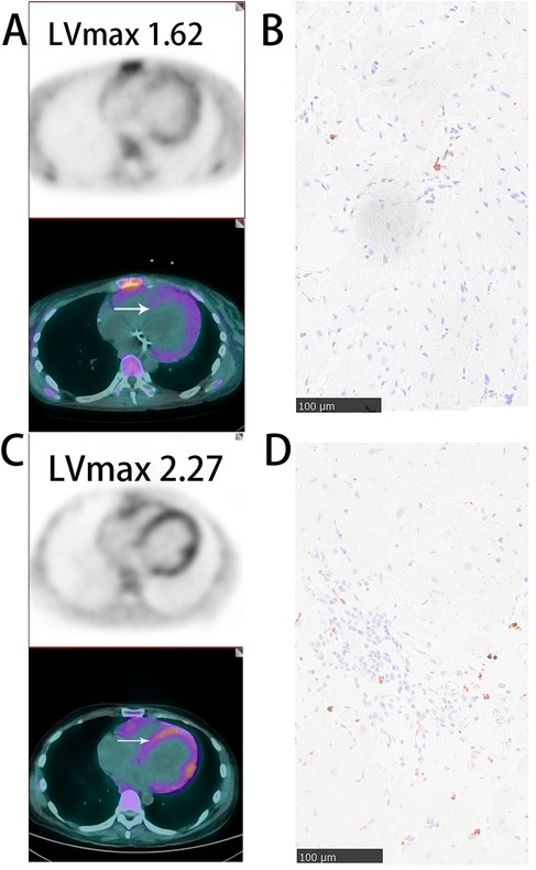 Medical imaging panel showing two PET-CT images and two histology slides. Panel A displays a PET-CT scan with a lesion size of LVmax 1.62; a highlighted area is marked. Panel B is a histology slide showing scattered cells. Panel C displays a PET-CT scan with a lesion size of LVmax 2.27; a different highlighted area is marked. Panel D shows a histology slide with more densely packed cells than in panel B.