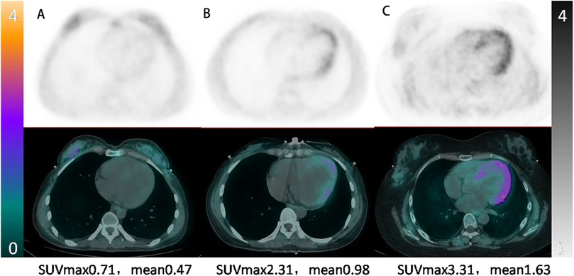Three PET/CT scan panels display thoracic cross-sections with varying SUVmax and mean values. The top row shows black and white PET scans, while the bottom row overlays color-coded PET data on CT images. The scans show different metabolic activities, indicated by SUVmax values of 0.71, 2.31, and 3.31.