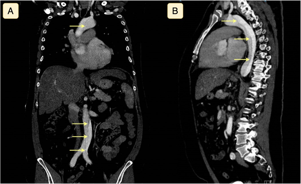 CT scan images showing panels A and B. Panel A is a coronal view highlighting the aorta with yellow arrows along its path. Panel B is a sagittal view, also marked with yellow arrows pointing to the aorta against the spinal column.