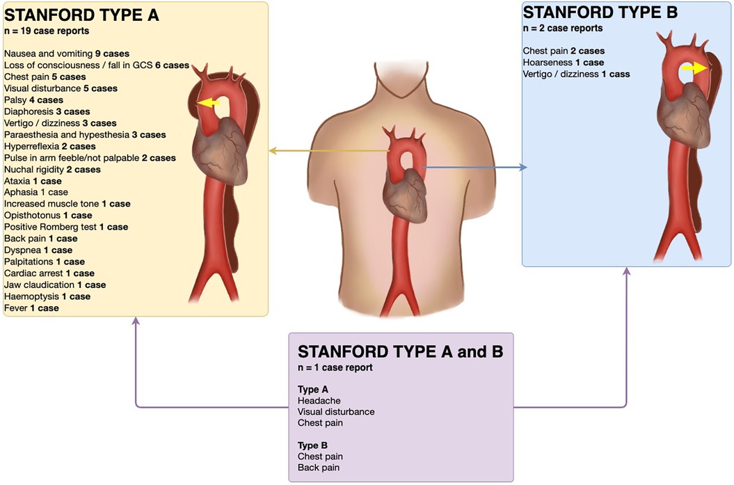 Diagram illustrating Stanford Type A and B aortic dissections with symptoms and case numbers. Left: Type A lists 19 cases with symptoms like nausea, chest pain, and dizziness. Right: Type B includes 2 cases with chest pain. Bottom: Type A and B combined with 1 case report. Annotations highlight affected areas on an anatomical illustration.