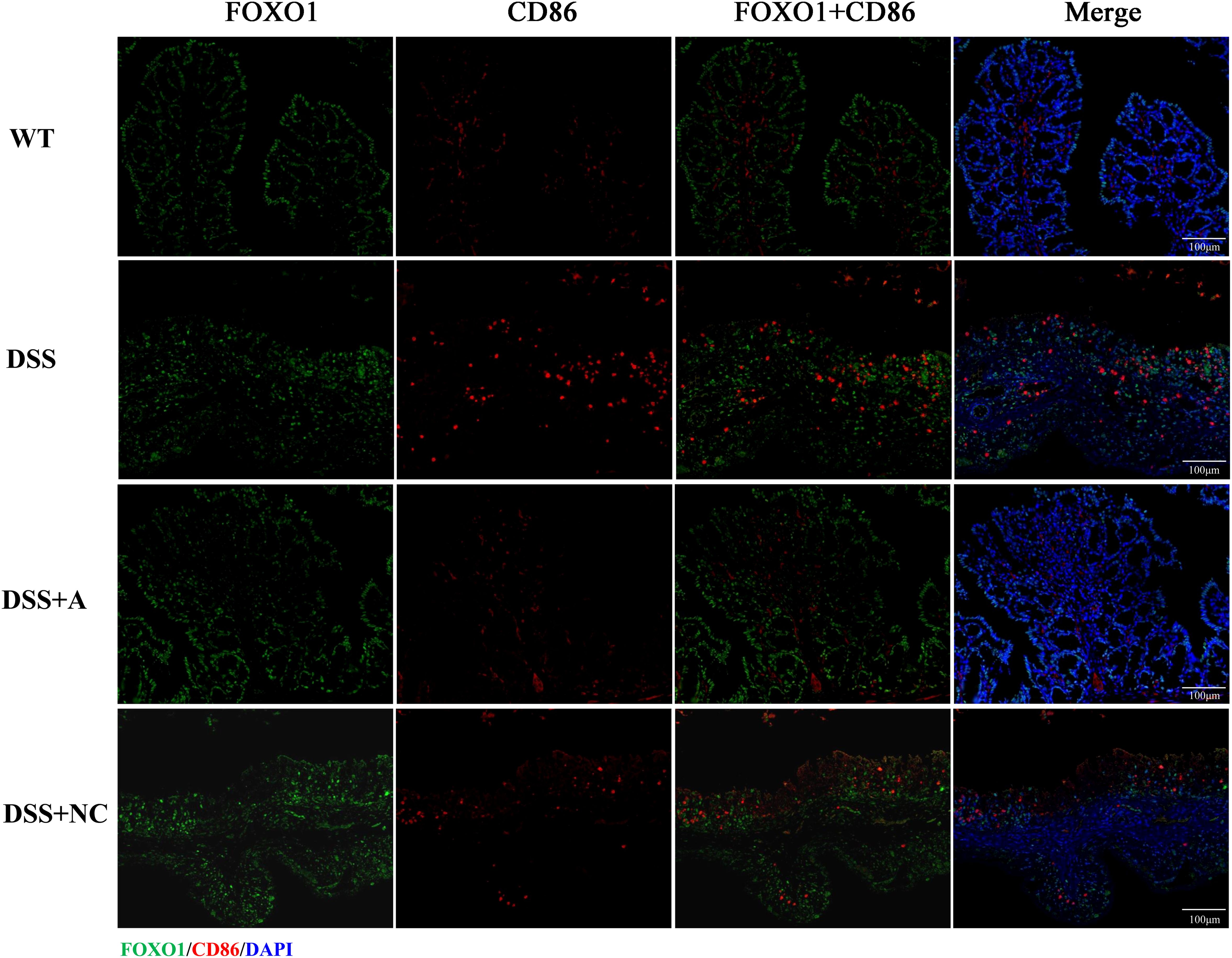 Fluorescence microscopy images show four rows labeled WT, DSS, DSS+A, and DSS+NC, with columns for FOXO1, CD86, FOXO1+CD86, and Merge. Green indicates FOXO1, red indicates CD86, and blue (DAPI) indicates nuclei. The merged images display tissue structures with varying expression across conditions, highlighting changes in FOXO1 and CD86. Scale bar is 100 µm.