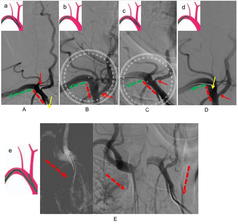 Medical diagrams illustrate vascular anatomy and procedure elements. Panels A to D show angiographic images with red and green dashed lines indicating vascular structures, along with arrows highlighting specific areas. Insets display simplified schematic views. Panel E has three angiographic views with red dashed arrows emphasizing certain pathways and an inset schematic at the top left also defining anatomical details.