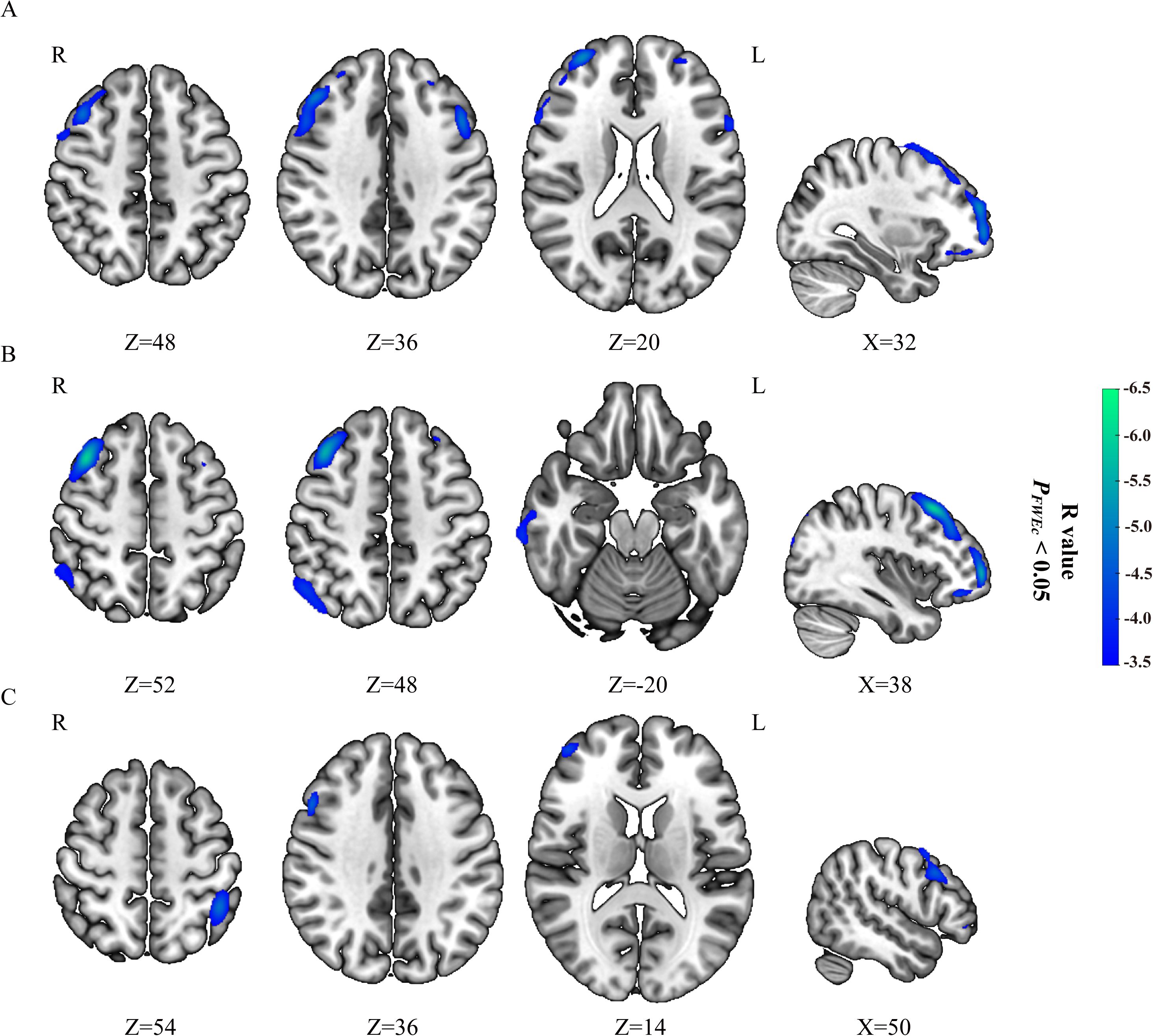 Three sets of brain significant metabolic clusters, labeled A, B, and C, display axial and sagittal views. Blue to green regions indicate significant areas with a color bar ranging from -3.5 to -6.5, representing R values with a statistical significance of p<0.05 family wise error correction at cluster level. Each set depicts different slice positions along the Z and X.