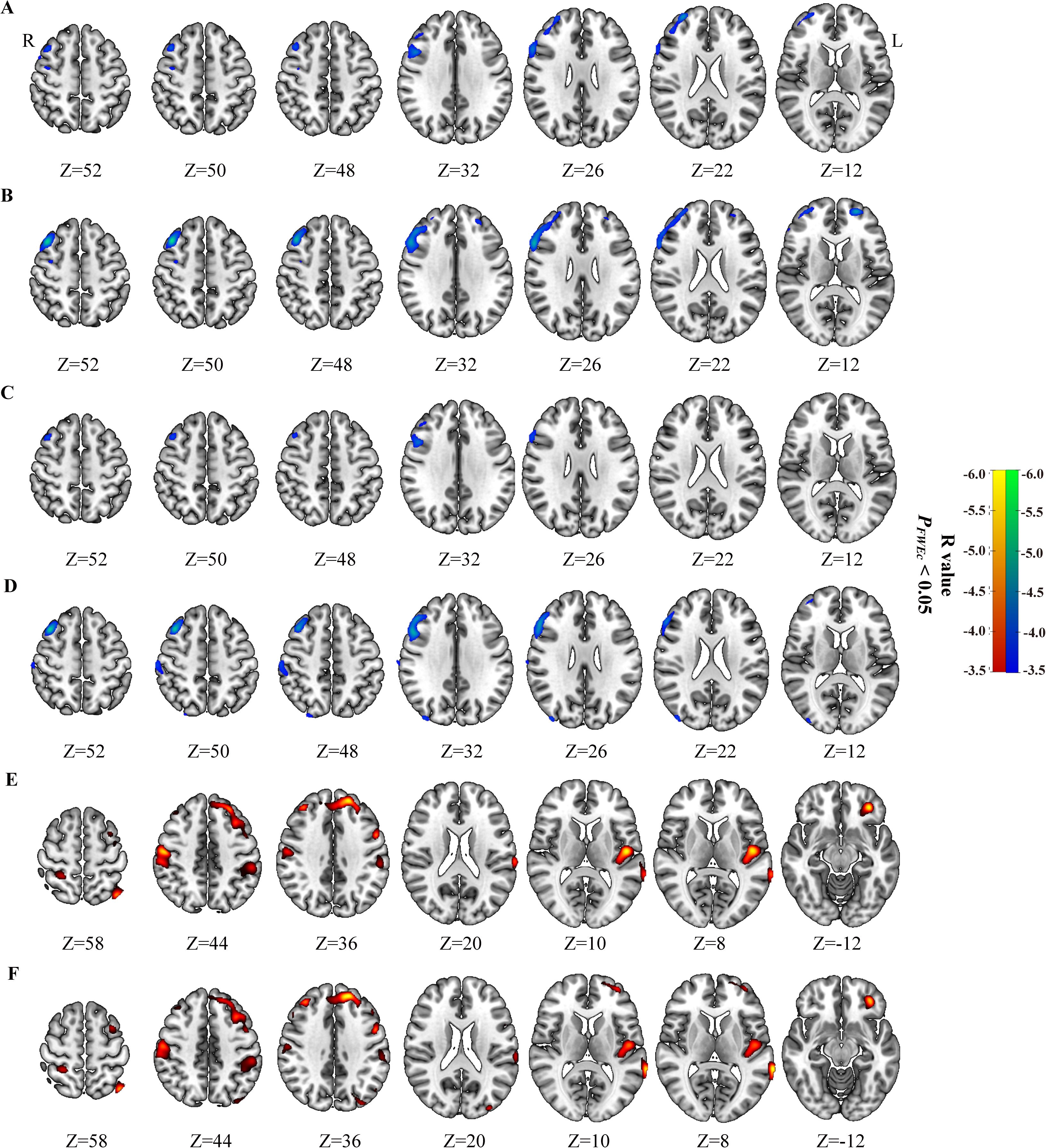 Six sets of Brain significant metabolic clusters, labeled A to F display axial views. Each set depicts different slice positions along the Z coordinates, ranging from Z=58 to Z=-12. Blue to green or Red to yellow regions indicate significant areas with a color bar ranging from -3.5 to -6.5, representing R values with a statistical significance of p<0.05 family-wise error correction at cluster level.