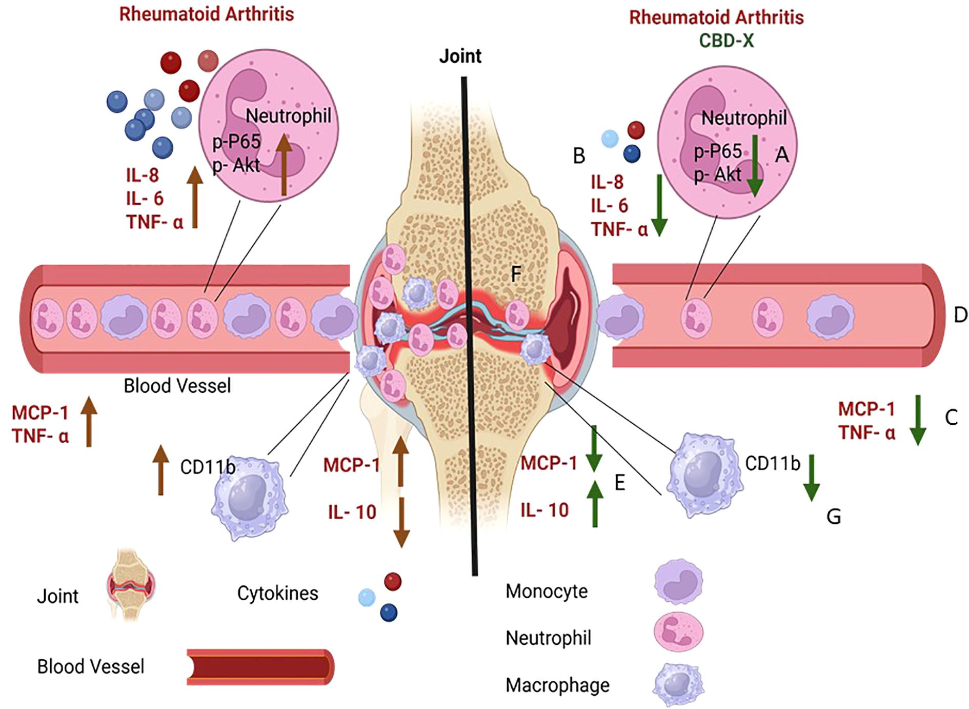 Diagram comparing joint inflammation in rheumatoid arthritis with and without CBD-X treatment. On the left, increased pro-inflammatory cytokines (IL-8, IL-6, TNF-alpha) and cell markers (MCP-1, TNF-alpha, CD11b) are shown, leading to inflammation. On the right, with CBD-X treatment, these markers decrease, accompanied by increased IL-10, indicating reduced inflammation. Key components include blood vessels, neutrophils, monocytes, and macrophages.