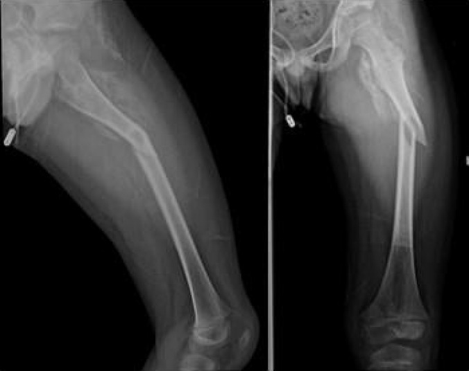 X-ray images of a canine leg show a complete fracture of the femur. The left image displays a lateral view, while the right image shows an anteroposterior view.