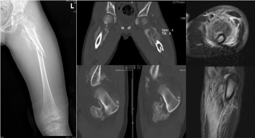X-ray and MRI scans of a femur showing a pathological fracture. The X-ray on the left displays a fracture in the femoral shaft. The MRI images on the right show cross-sectional views, illustrating irregularity in the bone structure and surrounding tissue, suggesting a possible lesion or abnormal growth contributing to the fracture.