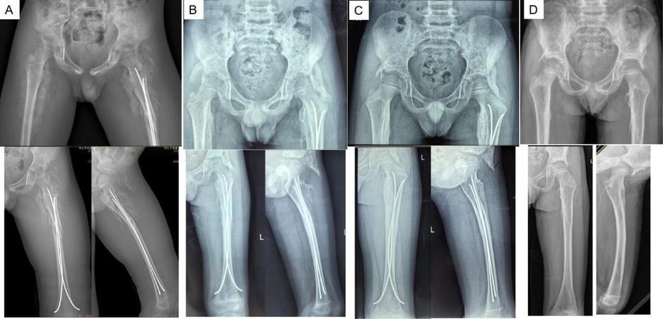 Four panels labeled A, B, C, and D feature X-rays of a pelvic region and femur. Panels A, B, and C show orthopedic rods along the femur, indicating surgical intervention. Panel D presents the healed bone without rods. Each panel includes different perspectives, showcasing the progression of treatment and healing.