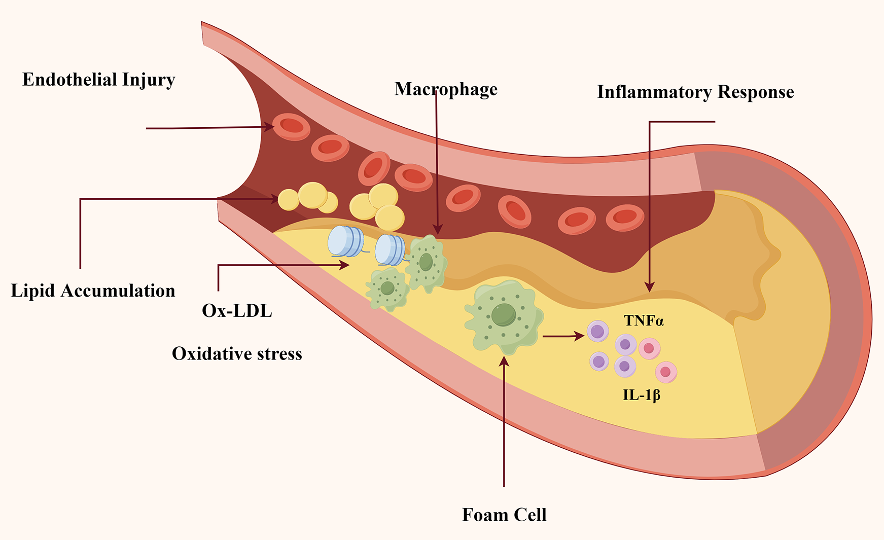 Cross-sectional diagram of an artery depicting the atherosclerosis process. Labels identify endothelial injury, lipid accumulation, oxidized LDL, oxidative stress, macrophages, foam cells, inflammatory response, TNF alpha, and IL-1 beta. The image illustrates the buildup of plaque within the artery, highlighting the immune and inflammatory responses involved.