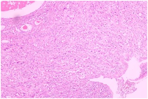 Microscopic image of pink-stained tissue with dense, wavy patterns indicating fibrous structures. Several round, white spaces and deeper shades of pink suggest cellular formations, typical of histological examination.