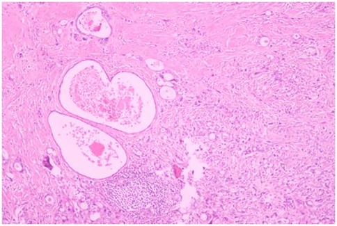 Microscopic view of tissue showing glandular structures, likely from a histological sample. The cells are stained pink and purple, highlighting their shapes and distribution within the tissue matrix.