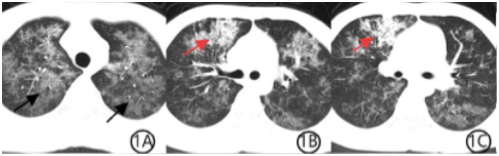 CT scan showing lung sections with varying degrees of abnormalities. Labeled 1A, 1B, and 1C, arrows point to areas with increased opacity, possibly indicating pathological changes such as infection or inflammation.