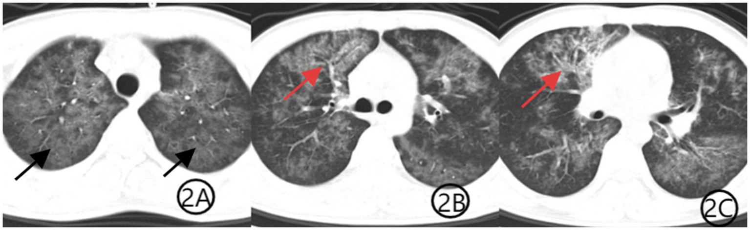 CT scan images show three panels labeled 2A, 2B, and 2C. Panel 2A indicates lung fields with arrows pointing to specific regions. Panel 2B shows a lung with a red arrow pointing to a denser area, indicating possible abnormalities. Panel 2C has a similar red arrow highlighting another area of interest in the lung.