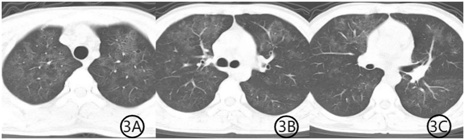 CT scan showing transverse sections of the lungs in three panels labeled 3A, 3B, and 3C. The lung fields appear dark with visible bronchi and blood vessels, and the mediastinum is centered.