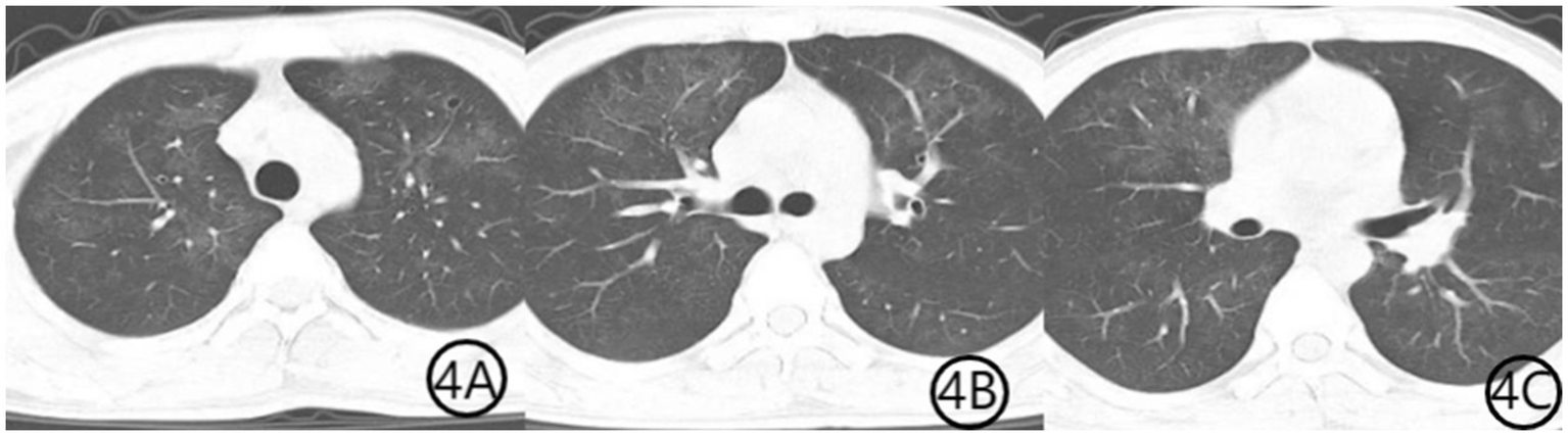 CT scans of the chest in axial view, labeled 4A, 4B, and 4C. Each image shows cross-sections of the lungs and surrounding structures, highlighting differences in anatomical features across the scans.