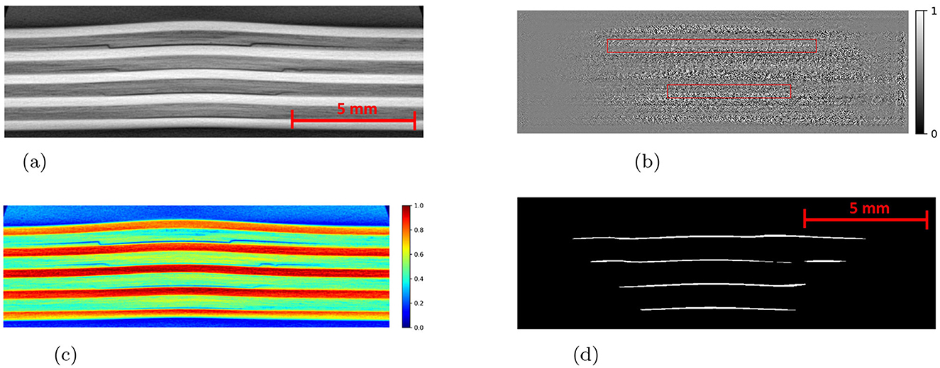 (a) CT slice showing layered structures with an impact energy of 7.5 joules, scale marked as 5 mm. (b) Grayscale attribution map with highlighted areas. (c) Color-coded attribution map with modified loss, showing intensity variations. (d) Predicted mask by Detectron2 highlighting detected lines against a black background, with scale marked as 5 mm.