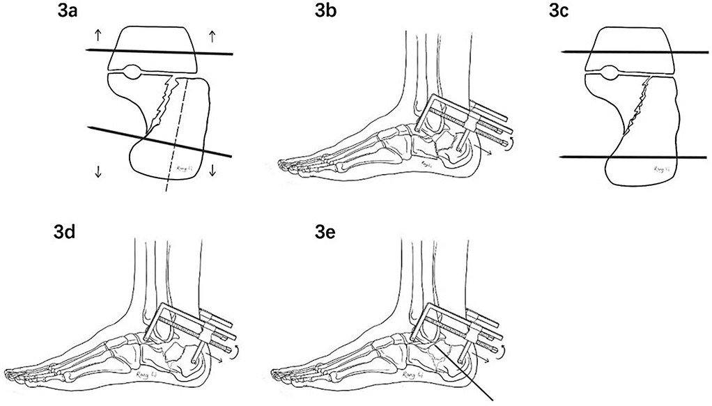 Five diagrams illustrate surgical steps for correcting a calcaneal fracture. Diagram three a shows bone separation with arrows indicating vertical correction. Diagram three b depicts a lateral view of the foot with surgical hardware. Diagram three c shows post-correction alignment. Diagrams three d and three e demonstrate lateral views of the corrected bone with different orientations of surgical hardware.
