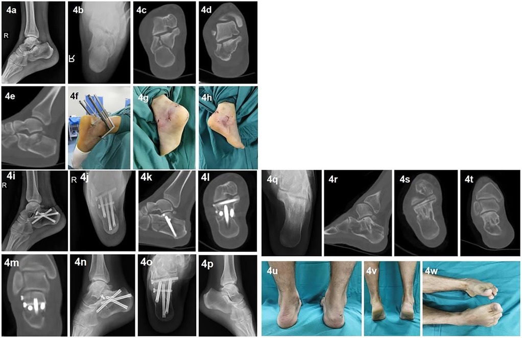 X-ray series and clinical photographs display foot views before and after surgery. Images 4a-4e show preoperative conditions; 4f-4p depict surgical procedures involving metal pins; 4q-4t show postoperative X-rays; 4u-4w present healed feet with surgical scars.