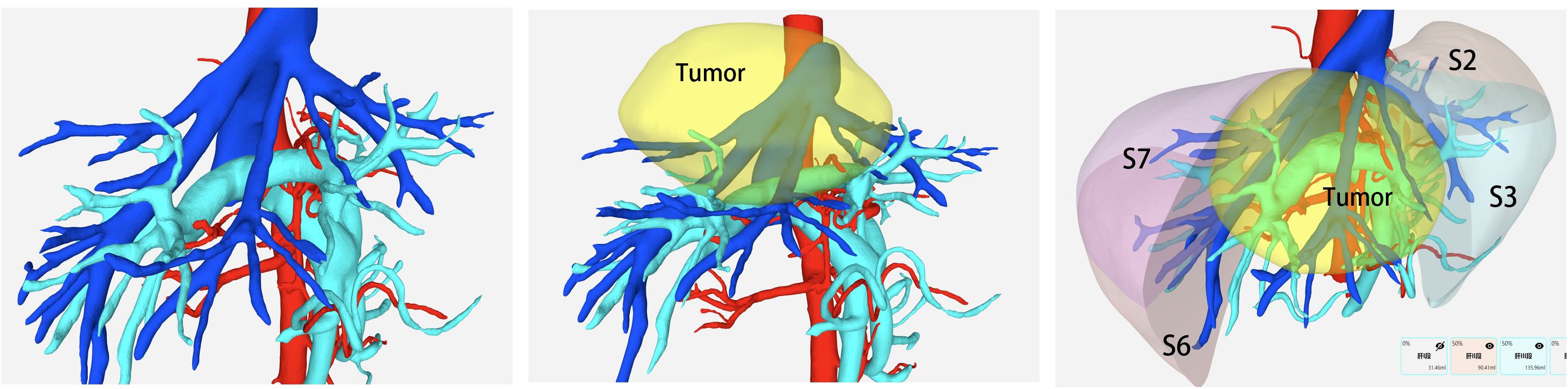 Three-panel medical illustration showing anatomical structures. The first panel displays detailed blue and red branching structures resembling blood vessels. The second panel shows similar branching with a yellow mass labeled “Tumor” near the center. The third panel illustrates the tumor with overlaying transparent sections labeled S2, S3, S6, and S7, highlighting its location relative to these segments.