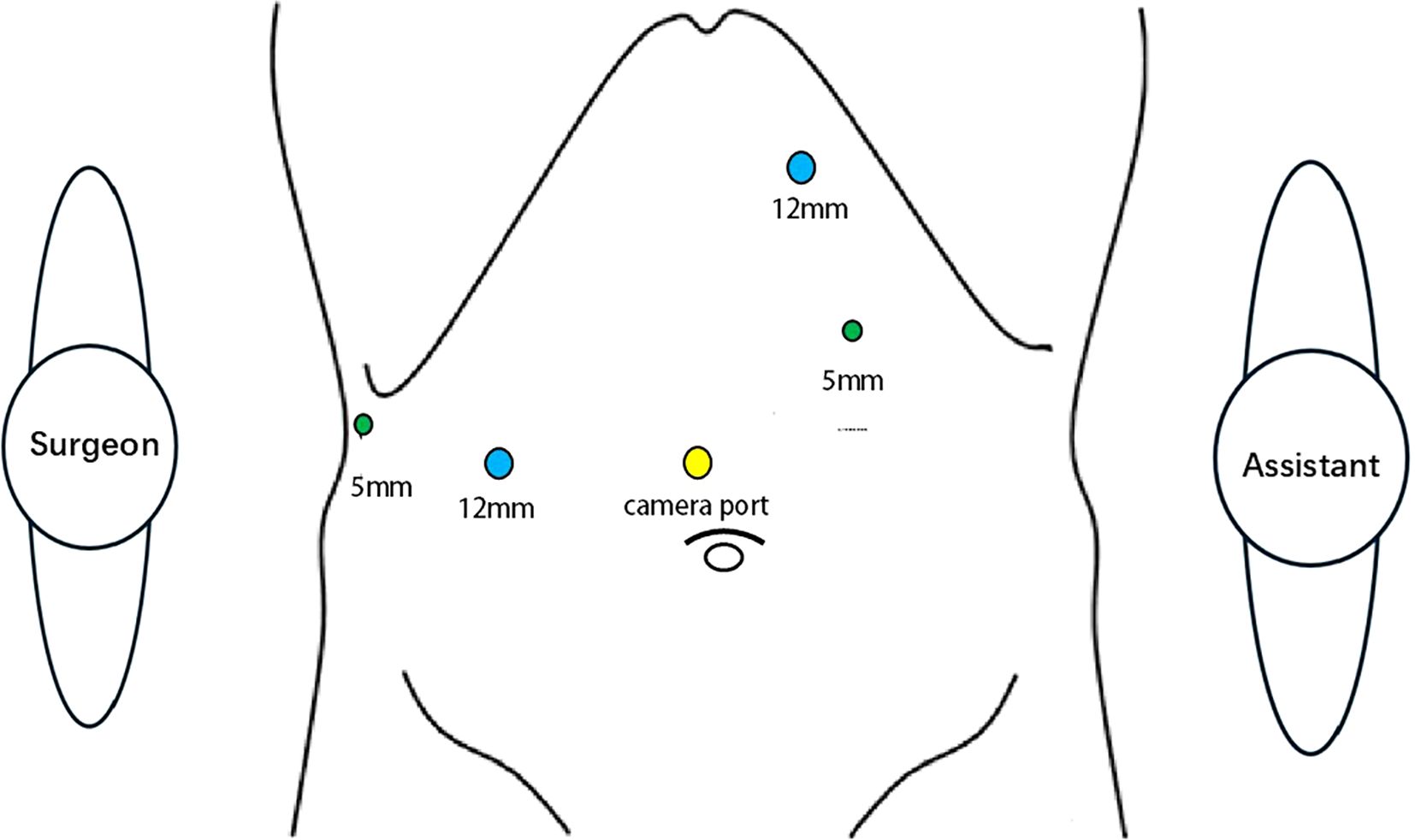 Diagram showing a surgical setup for a procedure. The layout includes a surgeon and an assistant positioned on opposite sides. Three marked ports on the surgical field are labeled: 5 millimeter, 12 millimeter, and camera port.