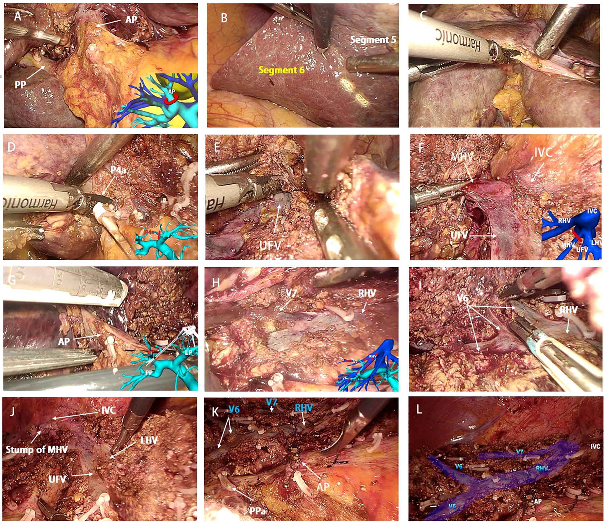 Twelve-panel image showing a surgical procedure involving liver segmentation and vascular structures. Each panel contains labeled parts such as the hepatic veins, segments, and instruments. Panels highlight different views and stages of dissection, emphasizing key anatomical features like the portal pedicle (PP), apical pedicles (AP), intersegmental planes, and veins (RHV, UFV, MHV, LHV). Diagrammatic overlays illustrate underlying anatomy. Labels include details such as segments, vein stumps, and surrounding liver tissue to provide context in the surgical process.