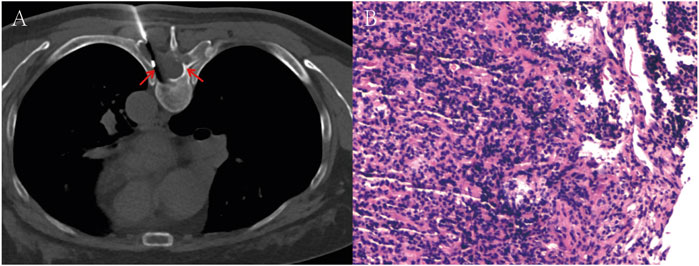 Panel A shows a CT scan of the chest highlighting a tumor with red arrows. Panel B presents a histological image of tumor tissue stained in purple and pink, indicating cellular detail.