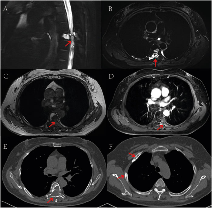 MRI and CT images of the thoracic region highlighting specific areas with arrows. Panel A shows a sagittal MRI of the spine. Panels B, C, and D display axial MRI scans with arrows indicating areas of interest near the spinal cord. Panels E and F are axial CT scans highlighting regions near the spine and lungs.