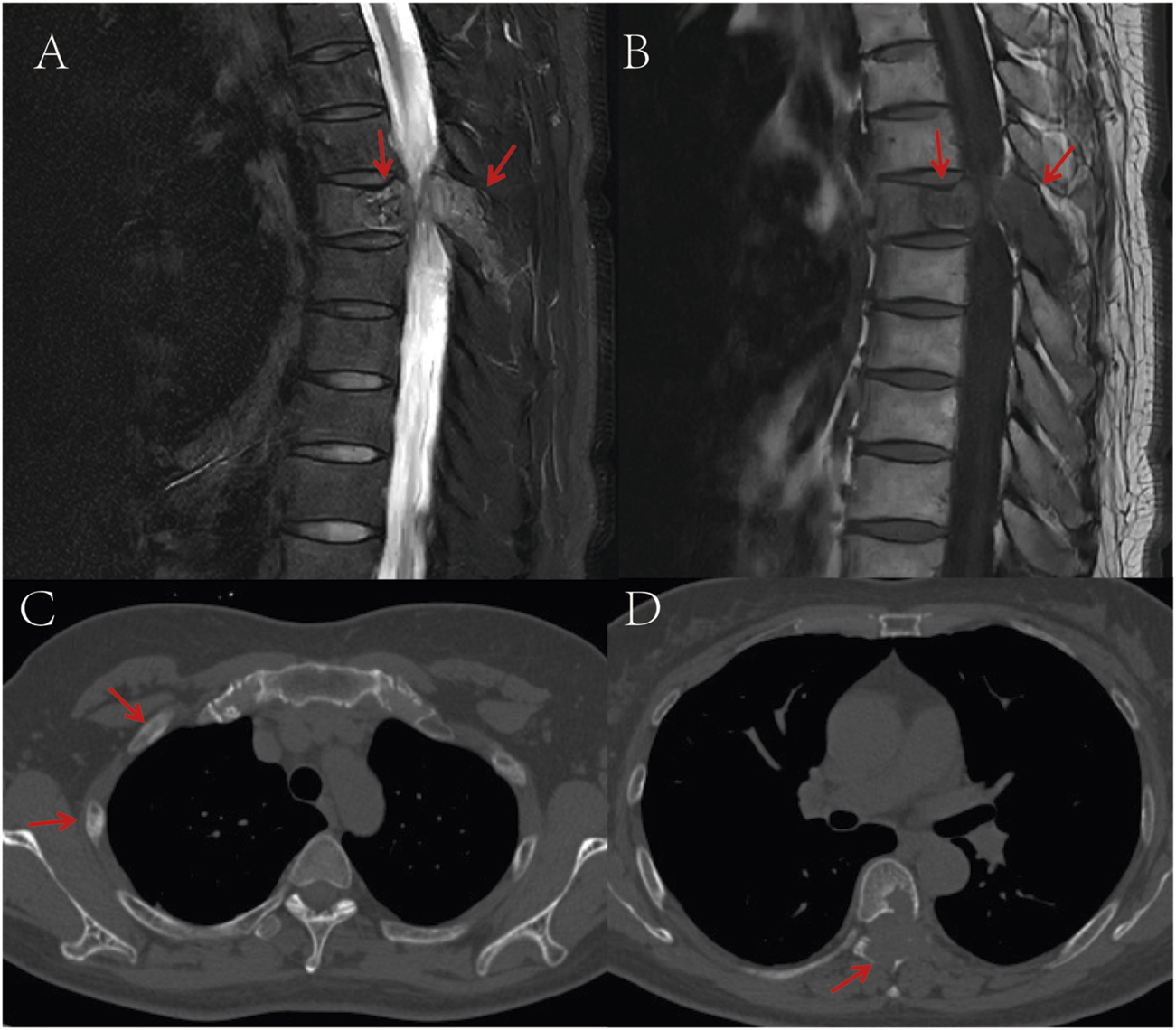 MRI and CT images showing thoracic spine and chest abnormalities. Image A and B display the thoracic spine with arrows indicating lesions or abnormalities. Images C and D are axial CT scans of the chest, highlighting specific areas of interest with arrows, such as masses or unusual structures.