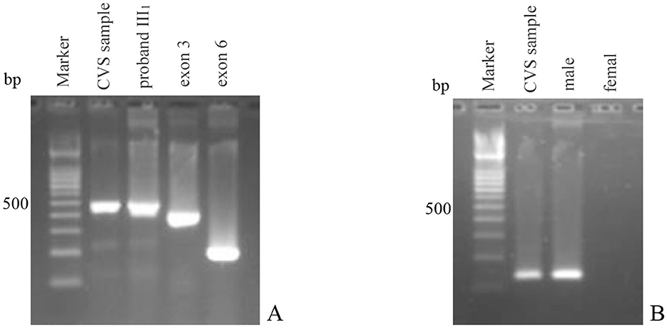 Gel electrophoresis image labeled A and B. Panel A shows lanes for Marker, CVS sample, proband III1, exon 3, and exon 6. The CVS sample shows positive junction fragment with no deletion of exon 3. Panel B shows lanes for Marker, CVS sample, male, and female. The CVS sample shows positive for the SRY gene, consistent with the male control.