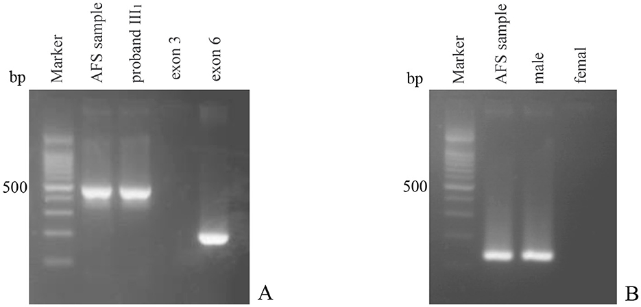 Gel electrophoresis image labeled A and B. Panel A shows lanes for Marker, AFS sample, proband III1, exon 3, and exon 6. The AFS sample shows positive junction fragment and exon 3 deletion. Panel B shows lanes for Marker, AFS sample, male, and female. The AFS sample shows positive for the SRY gene, consistent with the male control.