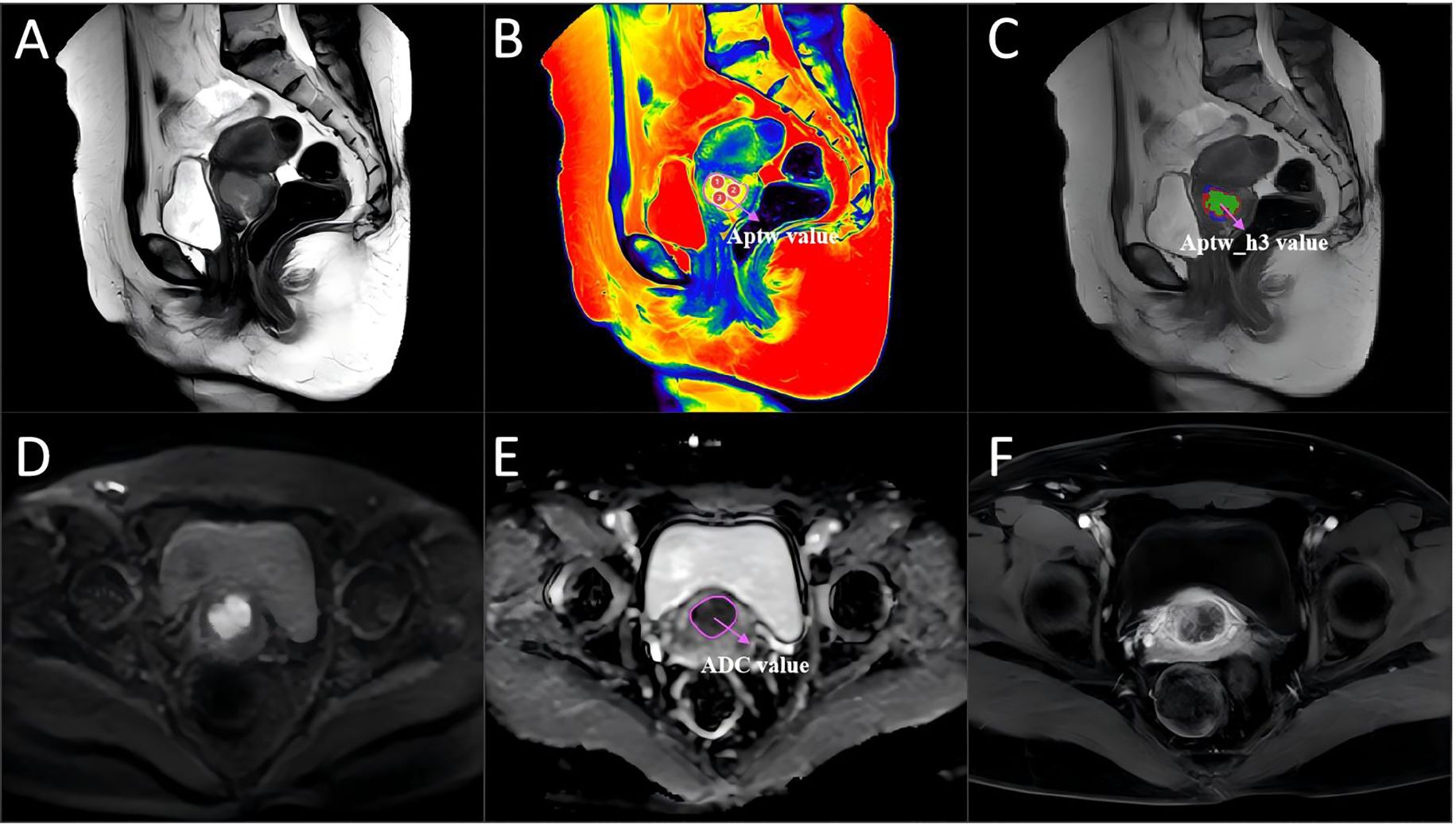 MRI images labeled A to F showing different views and measurements of a pelvic region. Panel A is a grayscale sagittal view. Panel B is a colored map indicating Aptw value. Panel C highlights the Aptw_h3 value. Panels D, E, and F are grayscale axial views with panel E highlighting the ADC value.