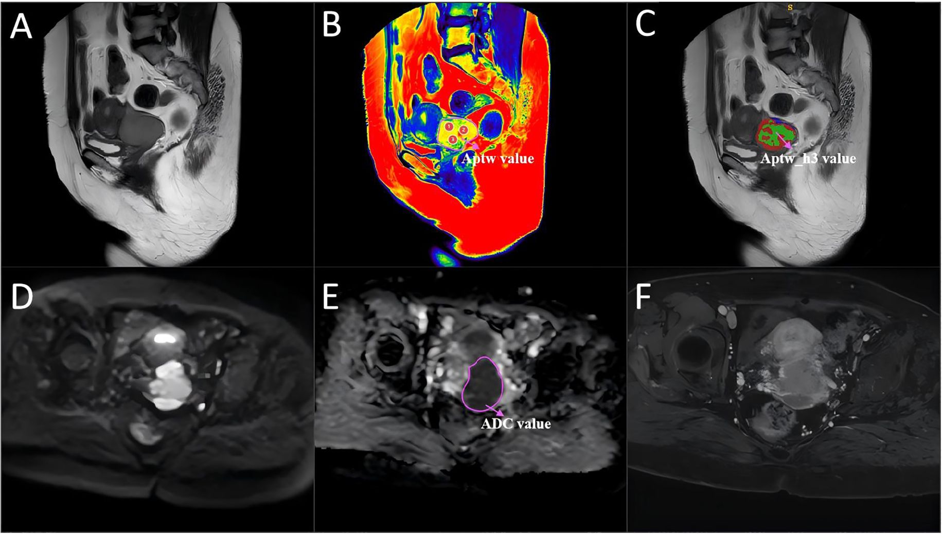 Six-panel medical imaging collage labeled A to F. Panel A shows a grayscale MRI scan. Panel B displays a colorful thermal map with “Aptw value” labeled. Panel C is a grayscale MRI with a highlighted area labeled “Aptw_h3 value.” Panel D features a darkly lit MRI. Panel E has a highlighted area with “ADC value” labeled. Panel F shows a grayscale MRI with various anatomical details.