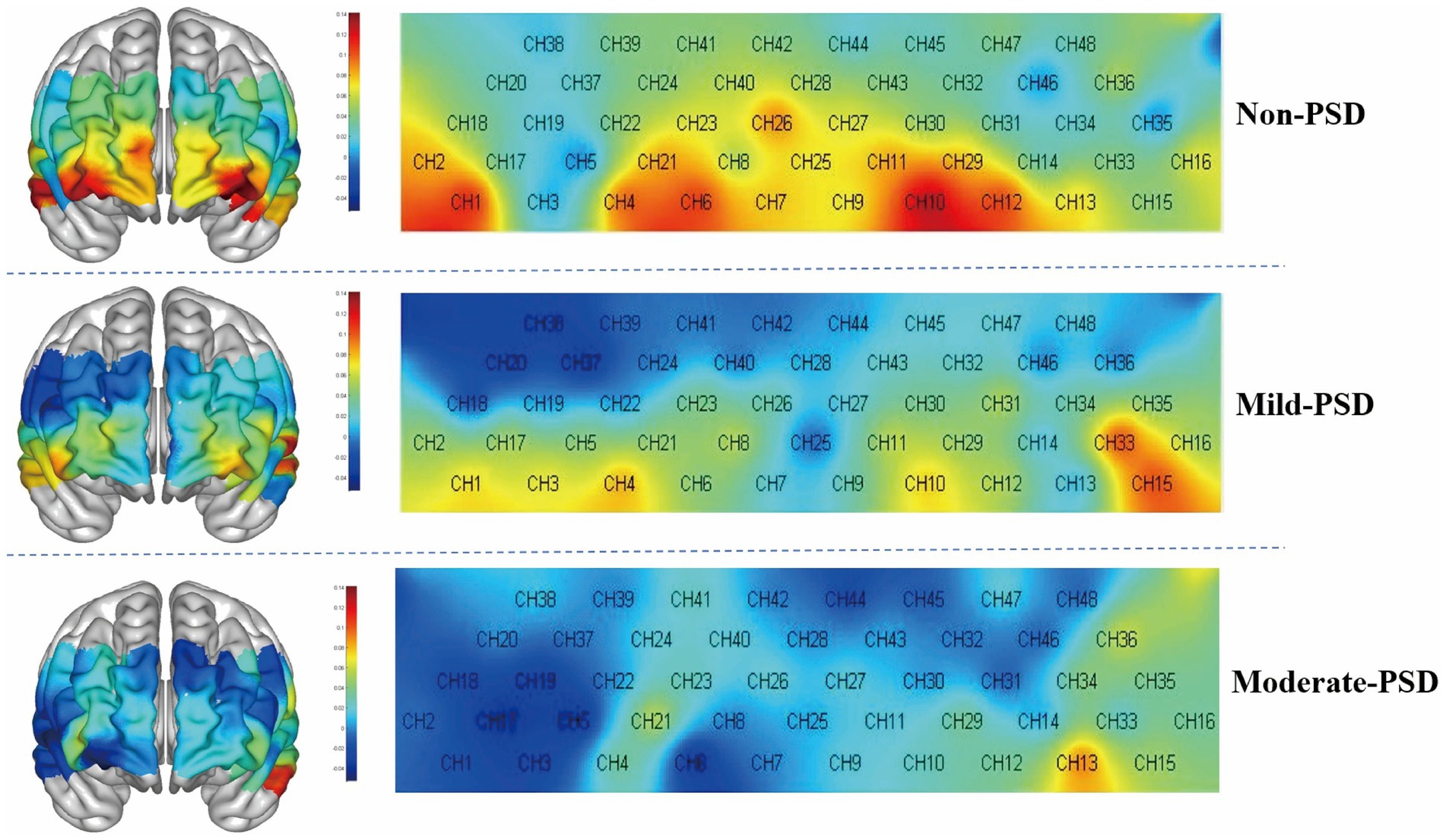 Three sections display channel-encoded brain activation maps, each labeled as Non-PSD, Mild-PSD, and Moderate-PSD. A blue-to-red color gradient represents activation intensity variations across channels. A color scale is on the left.