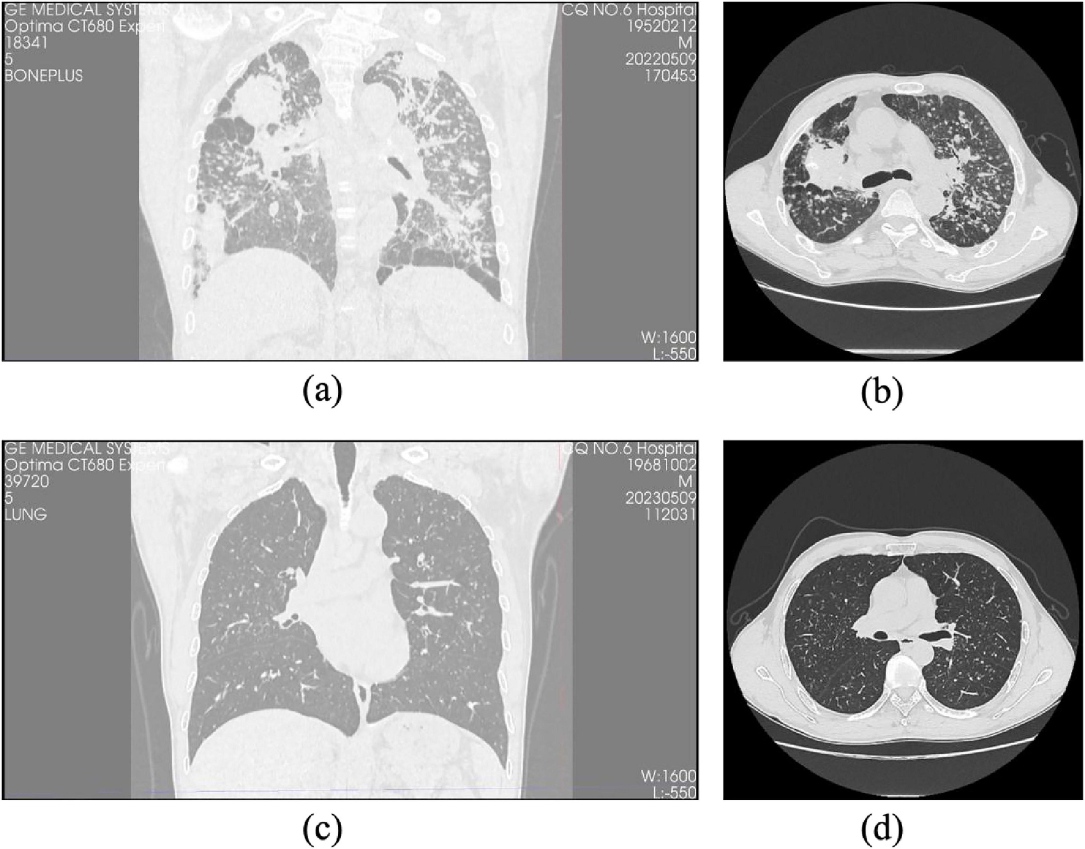 CT images of the lungs in two pairs. Pair (a) and (b) show coronal and axial cross-sections with notable opacities, likely indicating abnormal lung conditions. Pair (c) and (d) show clearer coronal and axial views with less visible opacities, suggesting healthier lung tissue. Each CT scan includes measurement details and identification codes.