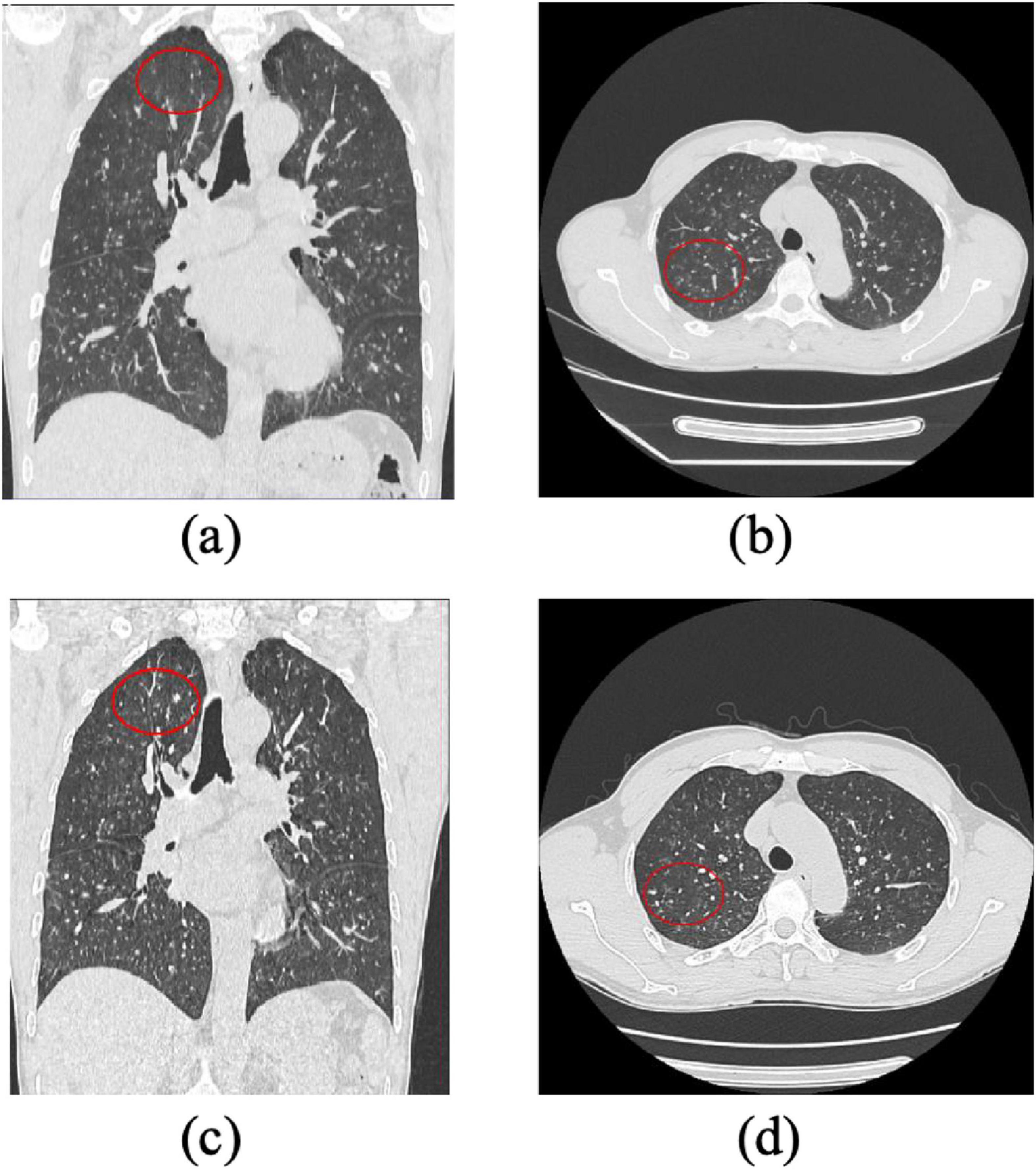 CT scans of the chest showing lung nodules highlighted with red circles. (a) and (c) display coronal views, while (b) and (d) present axial views. Each image highlights a different affected area within the lungs.