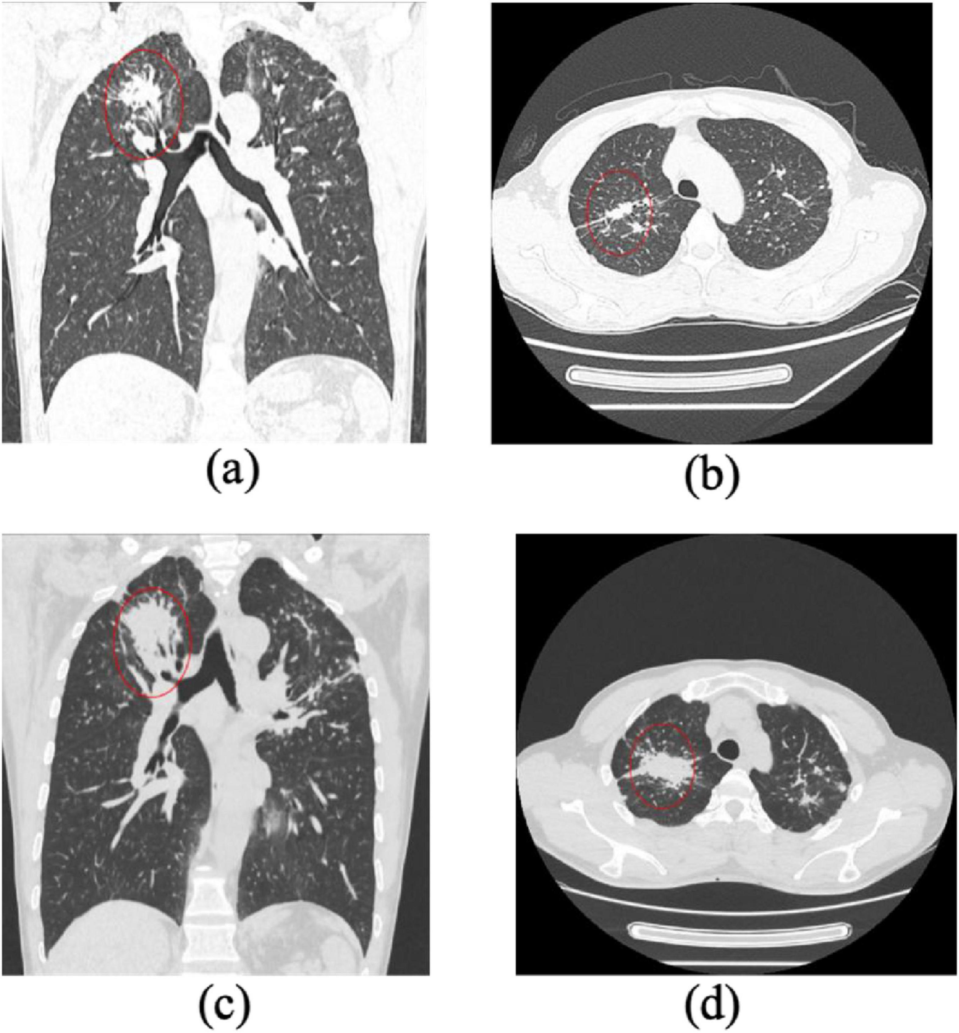 CT scan images showing various perspectives of a chest cavity. Images (a) and (c) display vertical cross-sections with highlighted areas in the upper lung region. Images (b) and (d) show horizontal cross-sections with circled areas in the lung fields, indicating areas of interest.