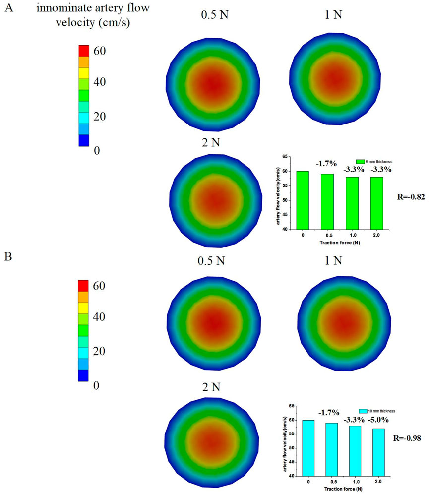 Color maps and graphs depict innominate artery flow velocity at different traction forces. Part A shows three circular maps for 0.5 N, 1 N, and 2 N with a bar graph indicating slight decreases in velocity percentages and a correlation of R=-0.82. Part B, also with three circular maps for the same forces, shows more significant velocity decreases, highlighted with a correlation of R=-0.98. Color scales represent flow velocity from 0 to 60 cm/s.