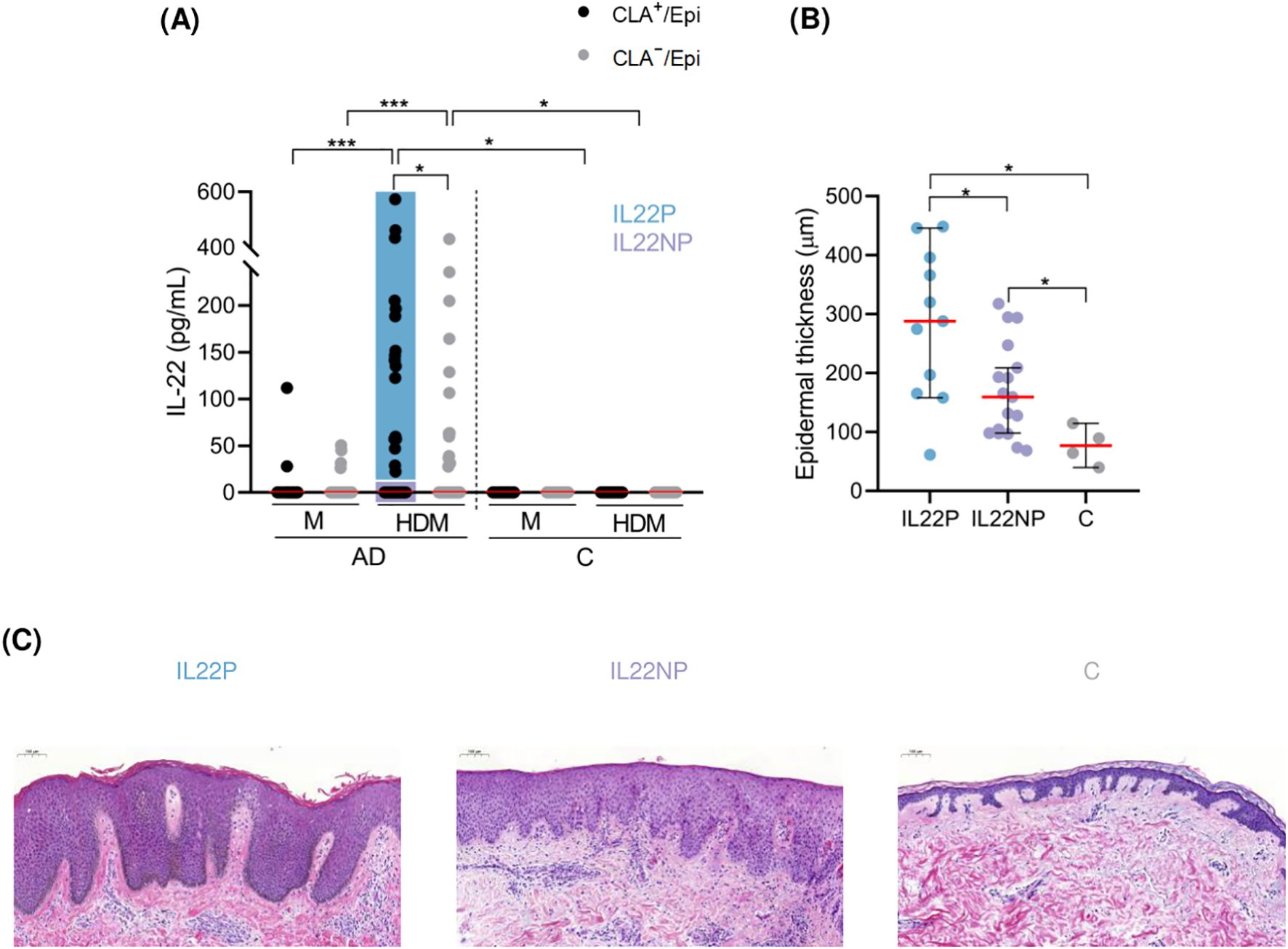 (A) Bar chart showing IL-22 levels in picograms per milliliter, with significantly higher levels in house dust mite (HDM) exposure for atopic dermatitis (AD) patients compared to controls (C). (B) Scatter plot illustrating epidermal thickness in micrometers, with IL-22 producers (IL22P) showing higher thickness than IL-22 non-producers (IL22NP) and controls (C). (C) Histological images of skin sections for IL22P, IL22NP, and control, depicting structural differences.