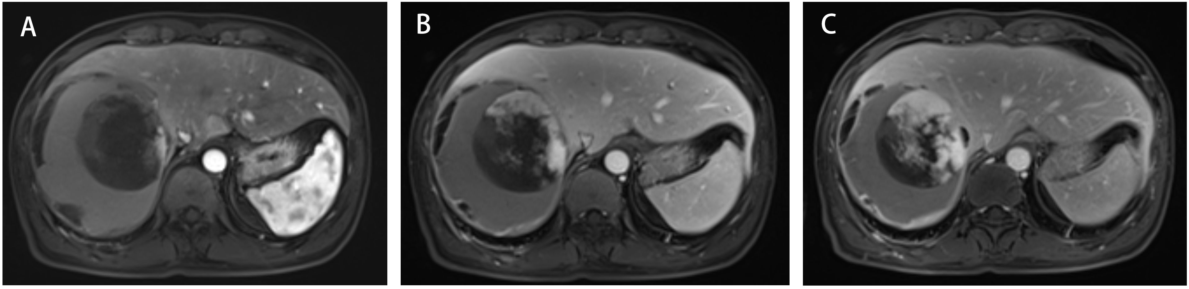 Three MRI scans labeled A, B, and C show different sections of the liver. Each image presents variations in tissue density and patterns, highlighting areas of interest within the liver. The scans are grayscale, with differences in contrast observable in each section.