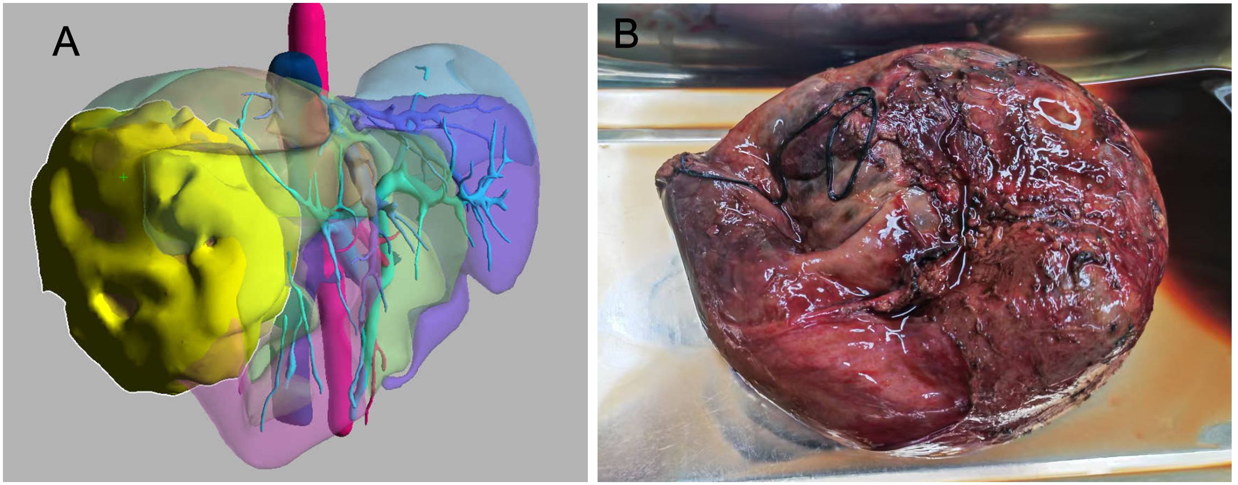 Panel A shows a 3D model of a liver with highlighted anatomical structures in different colors, including blood vessels and sections. Panel B displays a photograph of an actual liver with a sutured area, showing a glossy, reddish-brown surface.