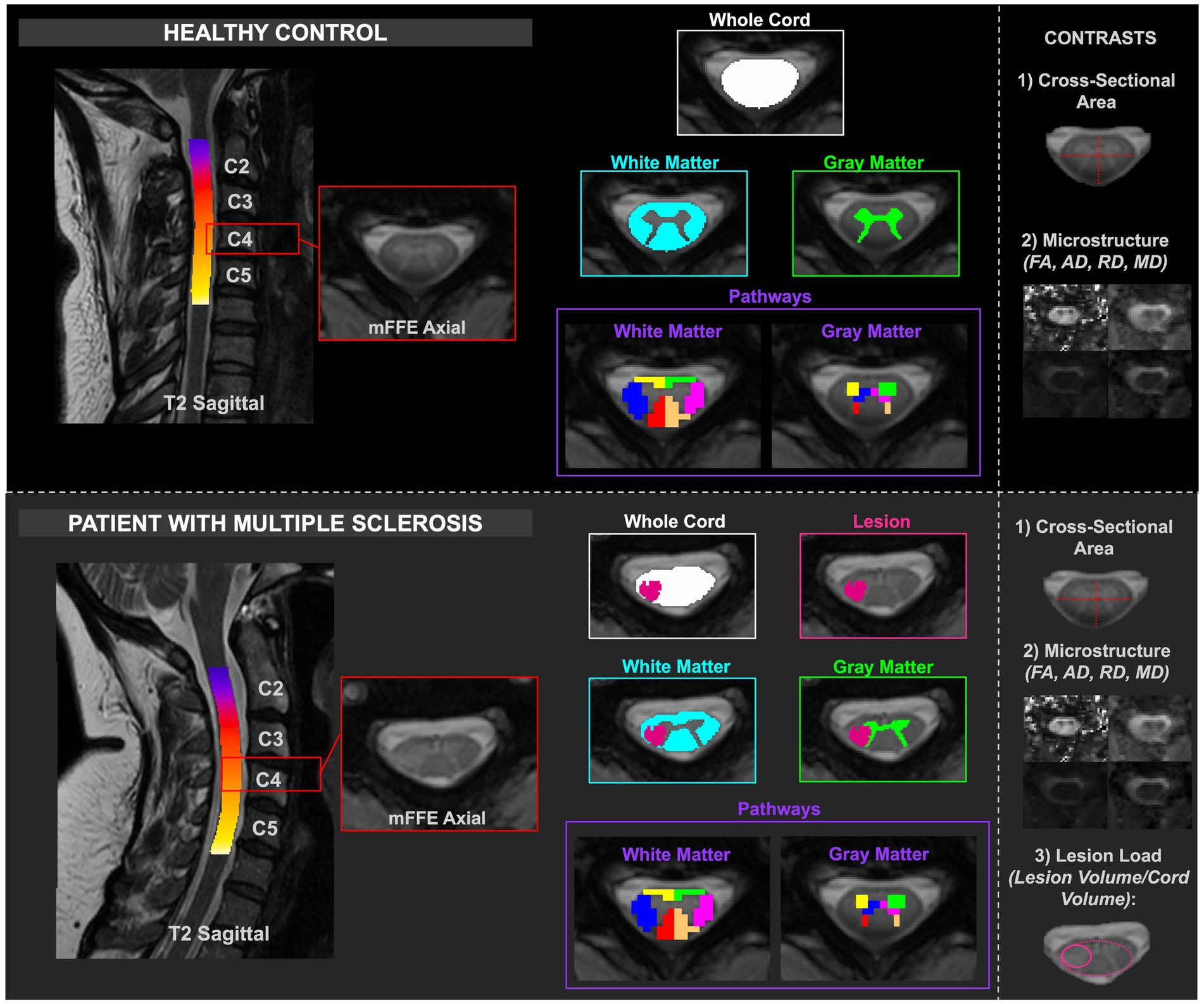 Comparative MRI scans of healthy and multiple sclerosis (MS) affected spinal cords. The top section shows a healthy control, highlighting C2 to C5 spinal segments with focus on the C4 axial slice. Visuals include whole cord, white and gray matter, and pathways. Contrasts display cross-sectional area and microstructure. The bottom section is for an MS patient, similarly highlighting spinal segments. It includes a lesion segment and shows contrasts with added lesion load alongside microstructure analysis.