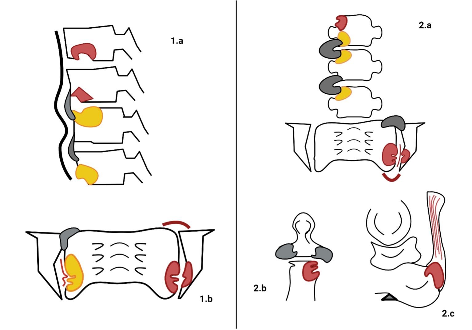 Illustration showing anatomical structures of the lumbar spine and associated systems in four diagrams. Diagram 1.a depicts a side view of lumbar vertebrae with highlighted intervertebral discs. Diagram 1.b represents a top view of a lumbar vertebra with associated ligaments and muscles. Diagram 2.a illustrates a stack of vertebrae with discs and associated structures. Diagram 2.b shows a cross-section view of a vertebra with notable cartilage and bone parts. Diagram 2.c depicts a side view of the pelvis and hip joint musculature.