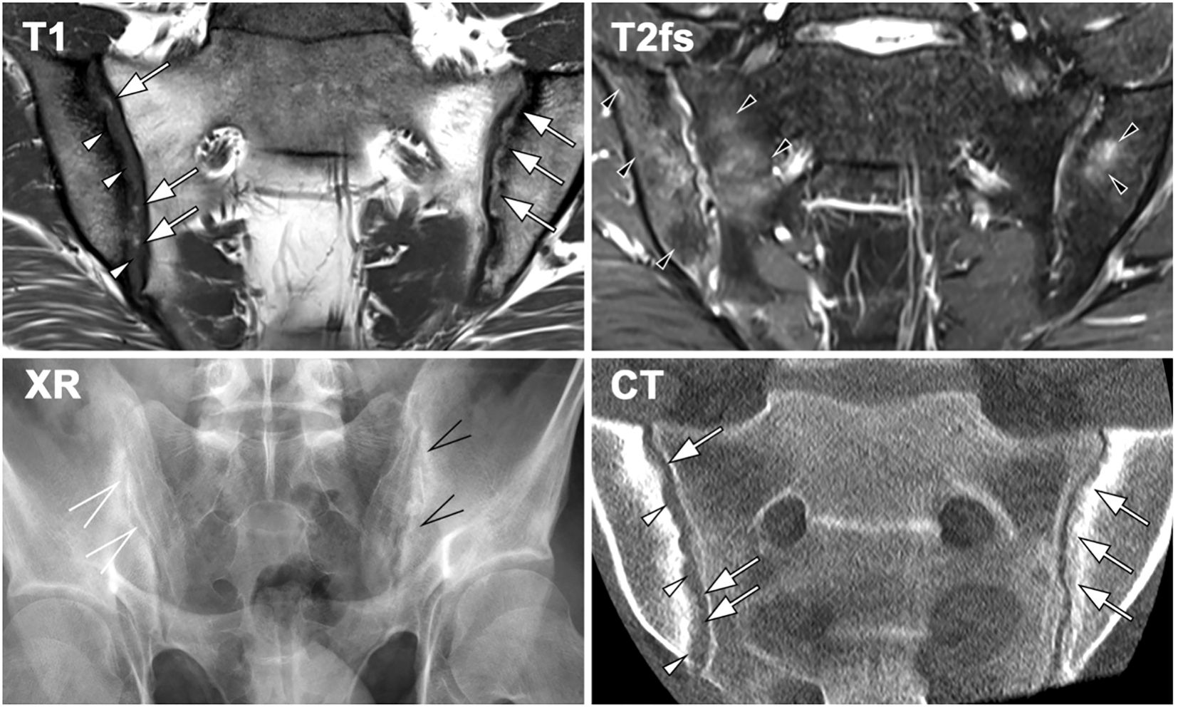 MRI and CT scans of the sacroiliac joints. Top left: T1-weighted MRI showing joint features with arrows indicating specific areas. Top right: T2-weighted fat-saturated MRI with similar indications. Bottom left: X-ray of the pelvis highlighting joint regions. Bottom right: CT scan detailing joint structures, with arrows pointing to areas of interest.