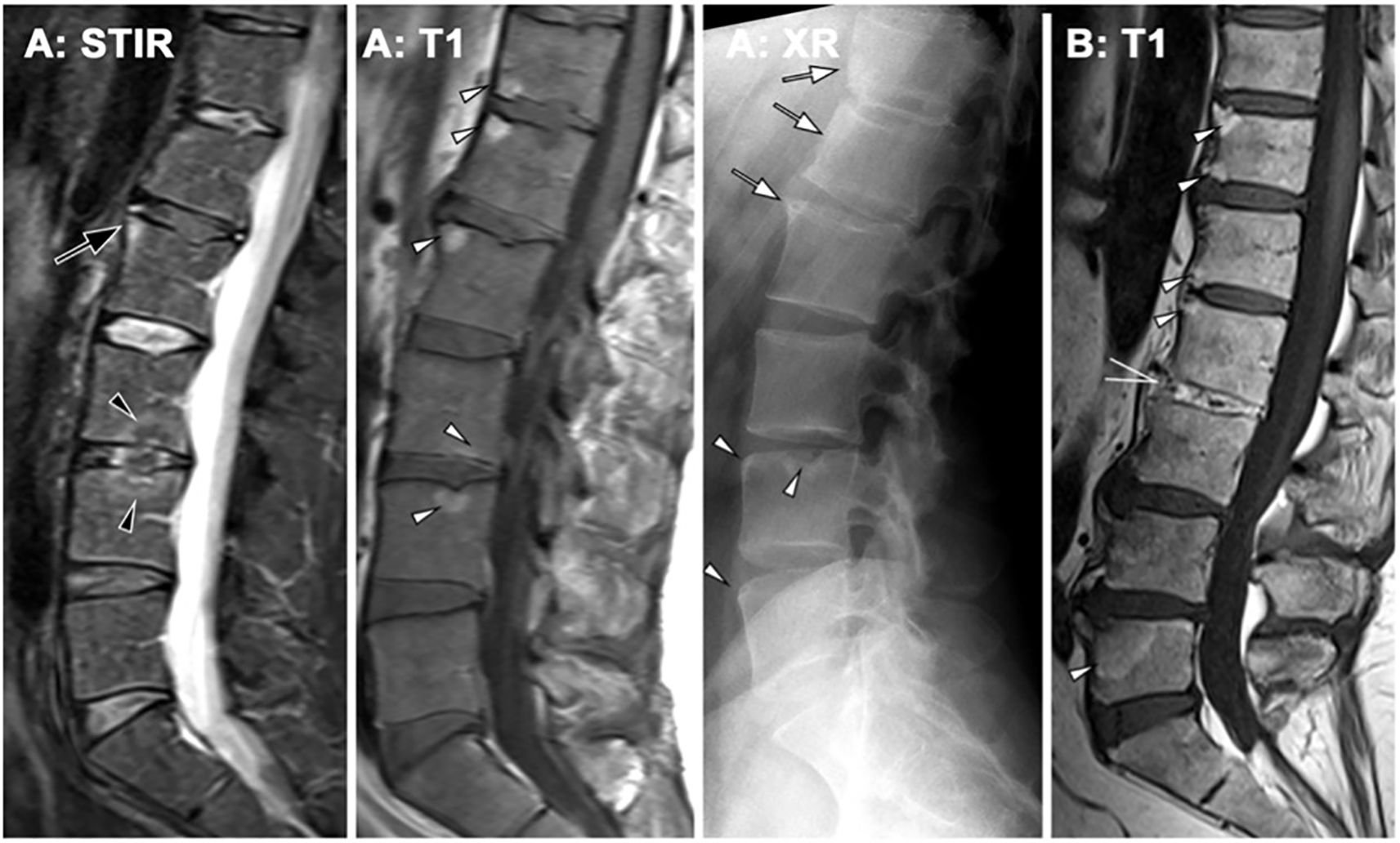 Four spinal images showing different scans: STIR, T1, XR, and another T1, highlighting a specific region of the lumbar spine. Arrows and arrowheads indicate areas of interest, possibly abnormalities or points of comparison.