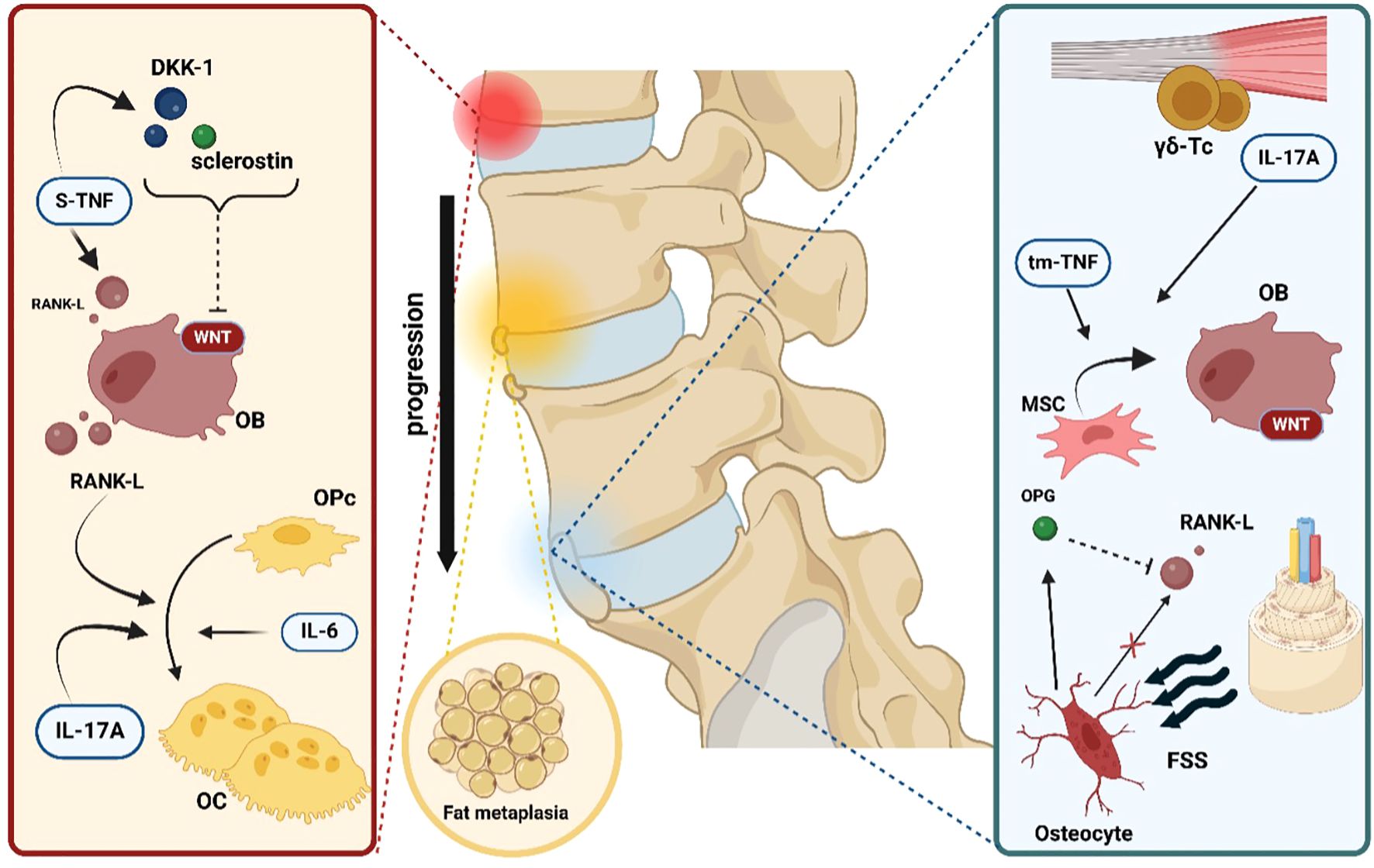Diagram illustrating the biological mechanisms involved in spondyloarthritis. It shows the roles of molecules like DKK-1, sclerostin, S-TNF, IL-17A, and RANK-L in bone progression and fat metaplasia. A spine section indicates inflammation and progression, with details such as OB (osteoblasts), OC (osteoclasts), MSC (mesenchymal stem cells), and FSS (fluid shear stress). The diagram ties bone and immune activity to structural changes.