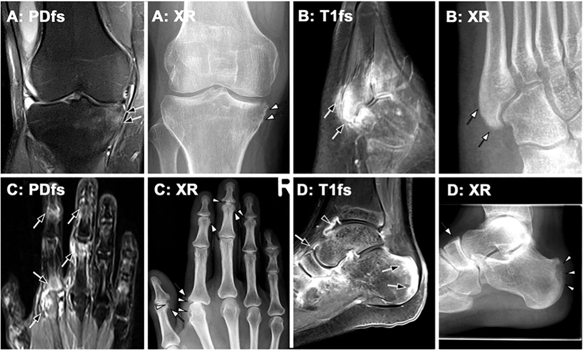 Group of eight medical images showing different imaging techniques of joints. Top row: Image A shows a knee in PDFS and XR formats, with arrows indicating specific areas. Image B shows an ankle in T1FS and XR formats, with arrows highlighting certain features. Bottom row: Image C displays fingers in PDFS and XR formats, marked with arrows. Image D shows a foot's side view in T1FS and XR formats, with arrows indicating noteworthy parts.
